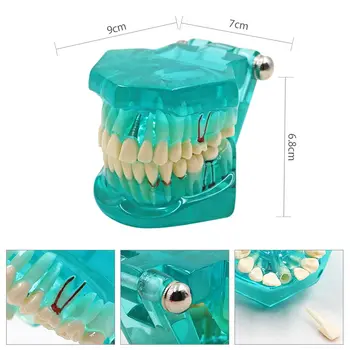 Nuimamas Dantų Dantų Modelį Su Restauravimo Tiltas Dantų Odontologas Naujų Stomatologas Lavinimo Dantų Mokymo Studijų