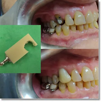 5 vnt 98 16mm PMMA nespalvoti disko 18 spalvų vienos spalvos PMMA dantų laikinas vainikėlis, tiltas