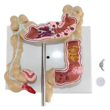 Storosios žarnos pažeidimas modelio žmogaus gaubtinės žarnos gyvatė storosios žarnos patologijos ligų modelio medicinos organizatorius anatomija